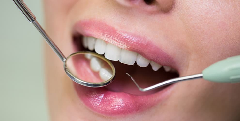 Dental Bridges